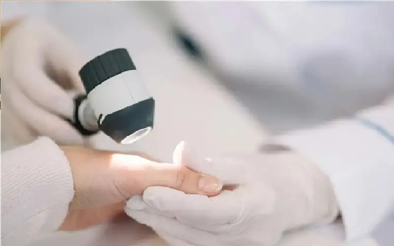 قريبا.. اختبار منزلي بسيط لسرطان الجلد