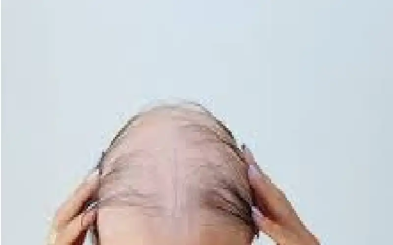 سبب تساقط الشعر وطرق طبيعية لإعادة