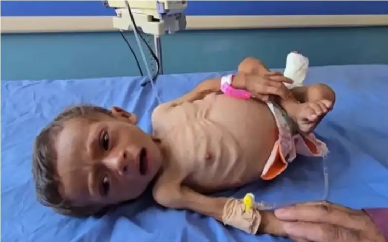 متلازمة غيلان باريه القاتلة في غزة..