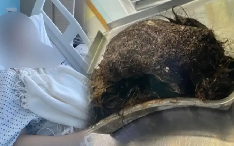 اخراج كتلة شعر في حجم بطيخة