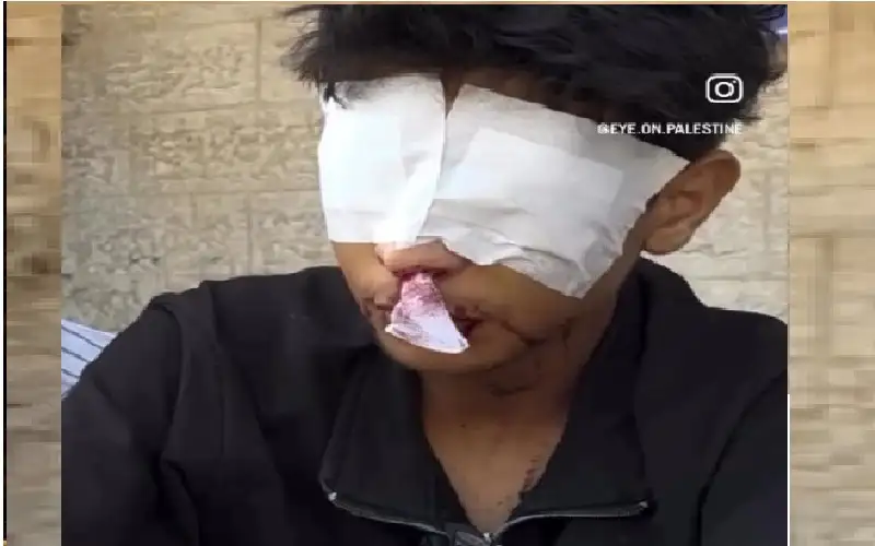 فقد بصره بالكامل جراء إصابته برصاص