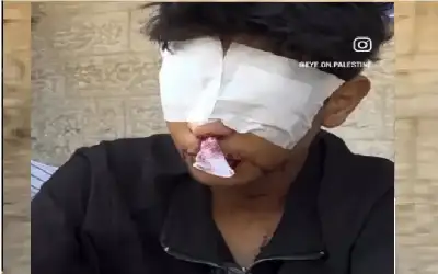 فقد بصره بالكامل جراء إصابته برصاص