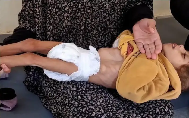 الأمم المتحدة: سوء التغذية الحاد بين