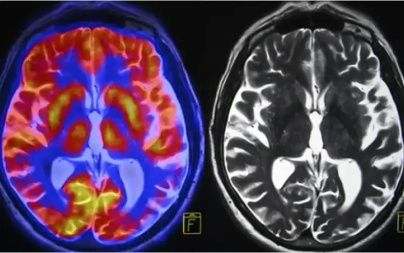 علماء: تصوير واحد بالرنين المغناطيسي يكشف