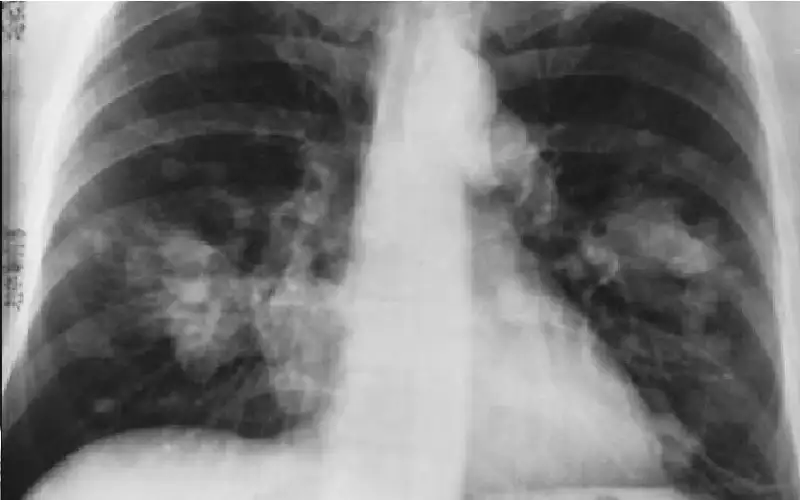 العدو الصامت.. نزلة برد بسيطة قد