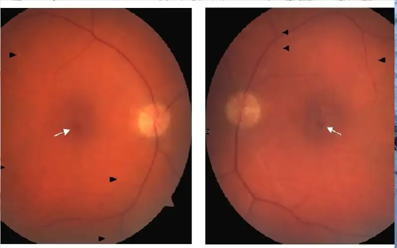 علاج جراحي جديد يقي العيون من