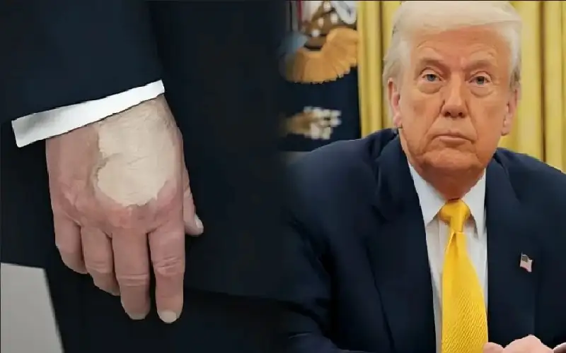 مجددا.. بقعة غريبة على يد ترامب