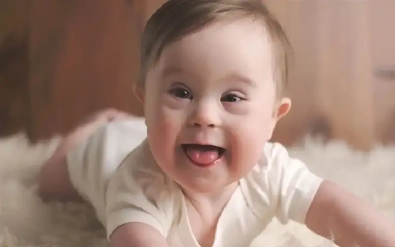 إنجاز علمي واعد في متلازمة داون..