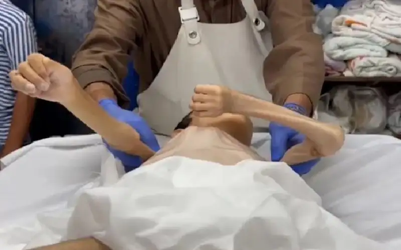 10 شهداء نتيجة المجاعة وسوء التغذية