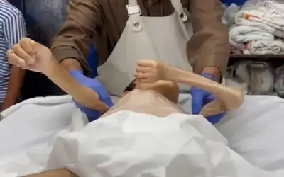 10 شهداء نتيجة المجاعة وسوء التغذية