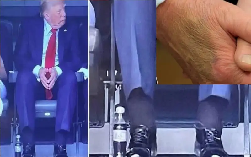 ترامب يعاني.. ولن يعود للحديث عن