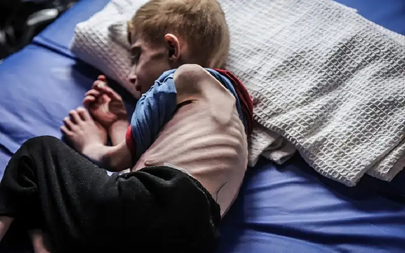 9 حالات وفاة نتيجة المجاعة وسوء