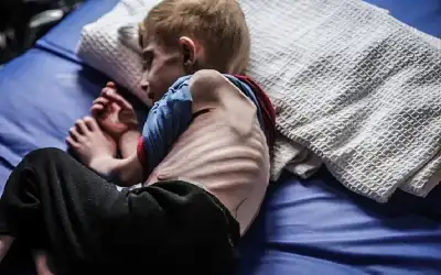 9 حالات وفاة نتيجة المجاعة وسوء