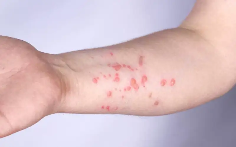 منظمة الصحة العالمية ترفع حالة الطوارئ