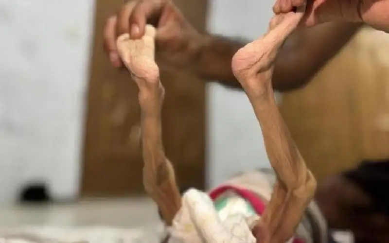 5 شهداء بينهم طفل نتيجة المجاعة