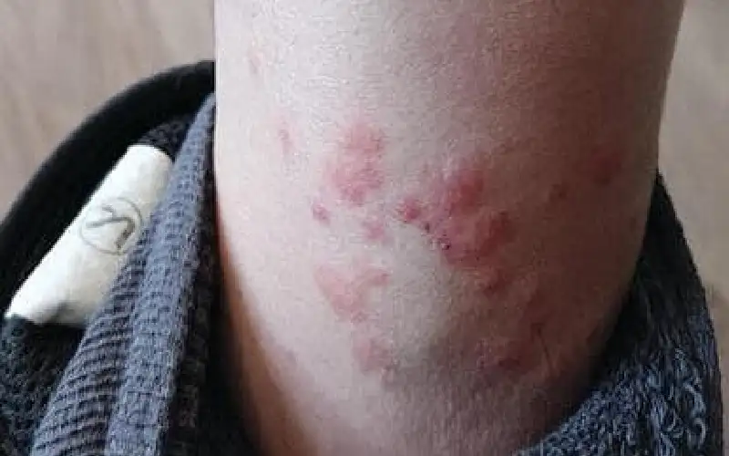 تقرير اسرائيلي: انتشار إصابات جلدية خطيرة