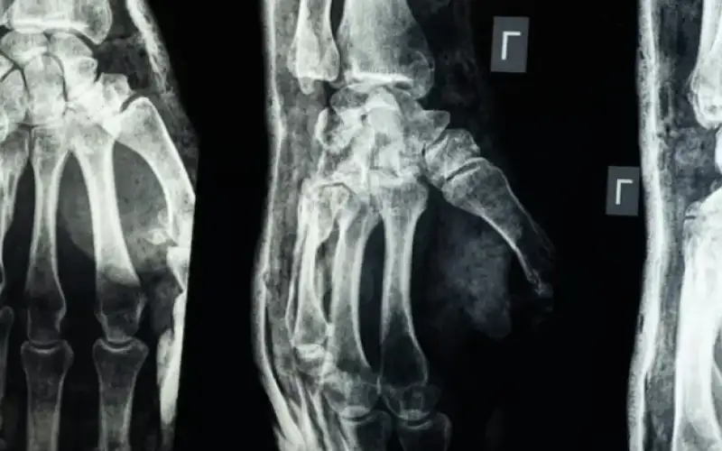 غراء عظمي .. ابتكار صيني لعلاج