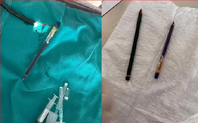 بسبب اضطراب نادر.. استخراج قلمين من