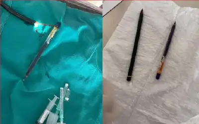 بسبب اضطراب نادر.. استخراج قلمين من