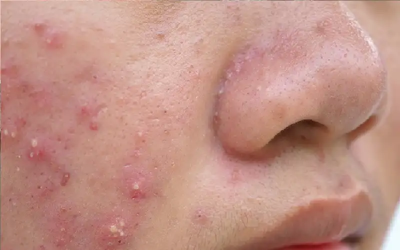 التهاب المؤثرين.. الوجه الآخر لخدع الجمال