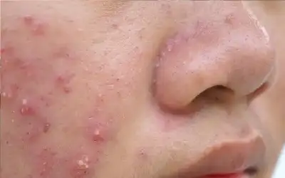 التهاب المؤثرين.. الوجه الآخر لخدع الجمال