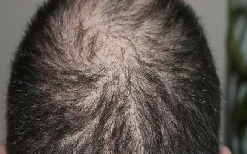 لتقليل تساقط الشعر.. التغذية والتصفيف والعلاجات