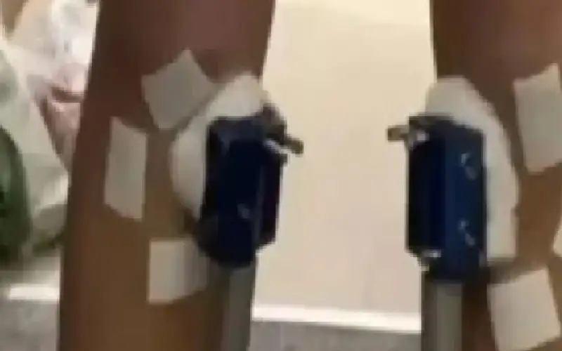 مراهق يدفع آلاف الدولارات لعلاج نمو