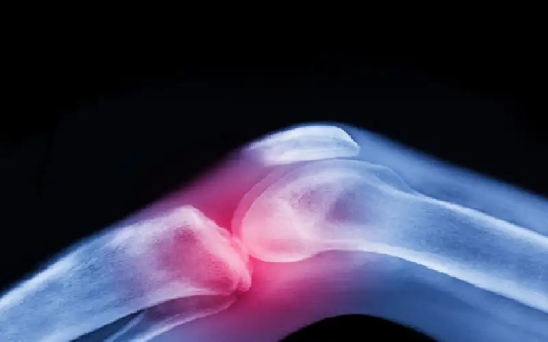 العلاج الأقوى لآلام المفاصل قبل اللجوء