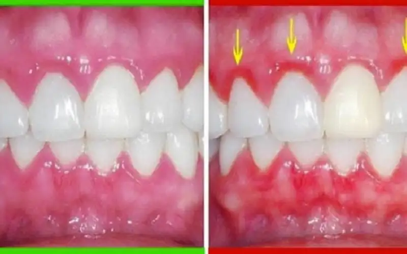 أهم علامات الإصابة بالتهاب اللثة