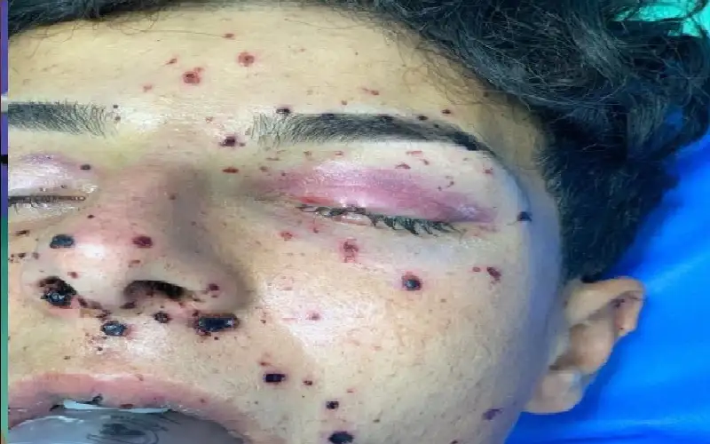 بعد انفجار بطارية سيارة في وجهه..