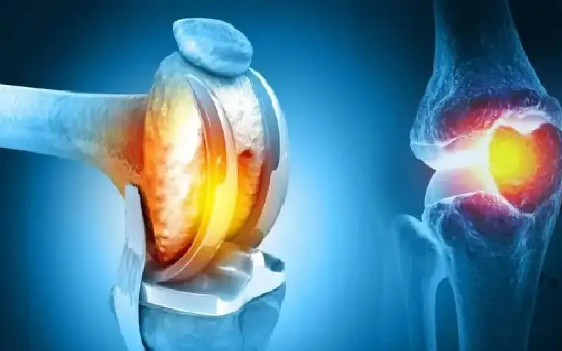 علاج واعد يخفف آلام الركبة دون