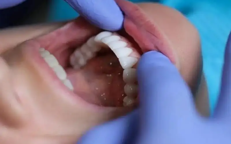 تسوس الأسنان يلحق ضررا بالدماغ