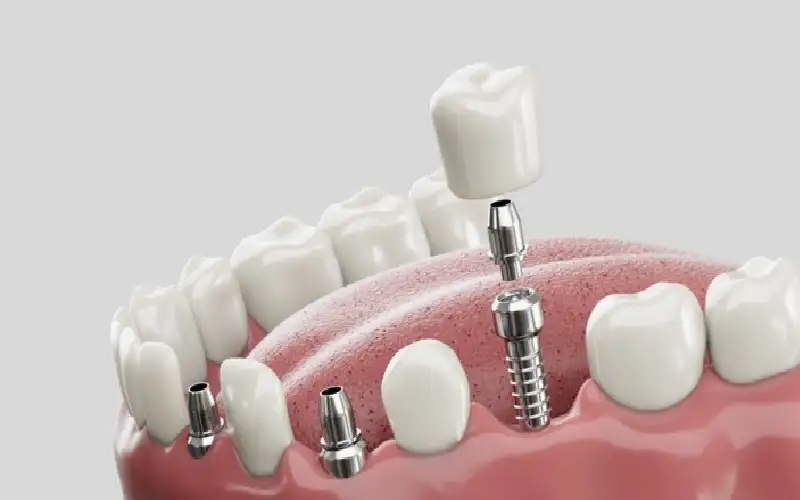 ثورة طبية.. زراعة الأسنان البشرية في