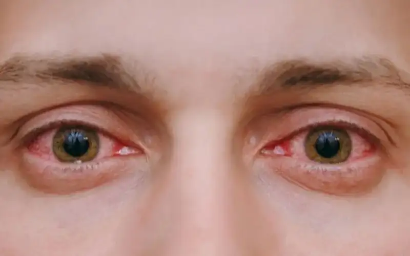 أسباب رمد العين وأنواعه