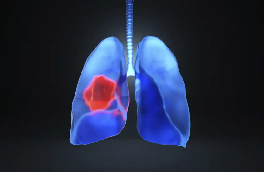 اكتشاف المحرك الرئيسي لتطور سرطان الرئة