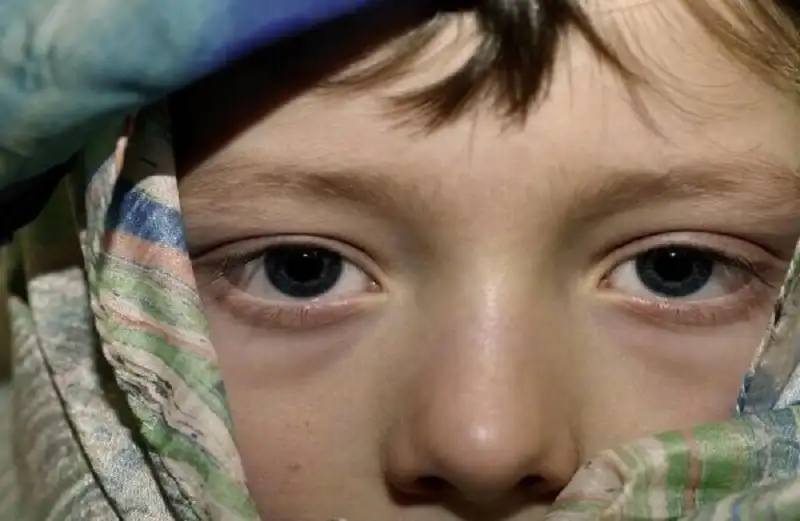 ألوان الهالات تحت العينين تكشف أمراضا