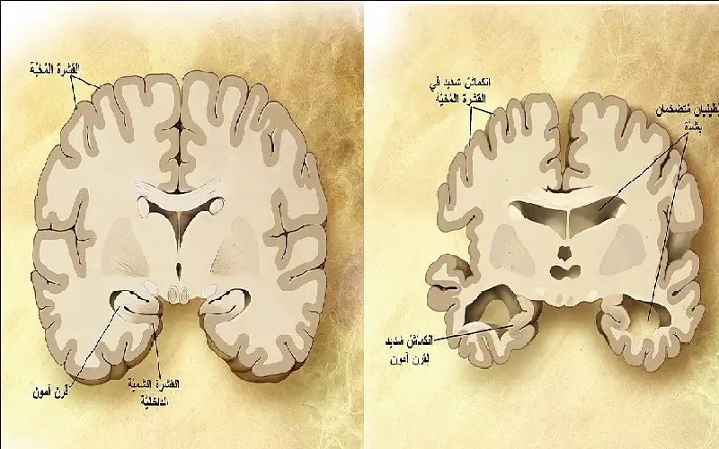 حين يمحو الزهايمر الذاكرة.. . لماذا