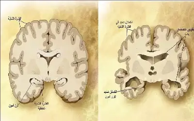 حين يمحو الزهايمر الذاكرة.. . لماذا