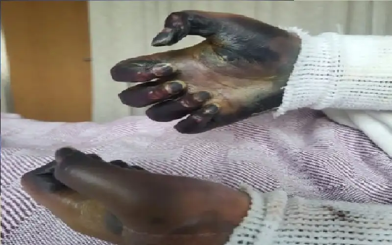 آلام بسيطة في الفك تنتهي ببتر