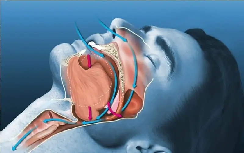 هل ترغب في التوقف عن الشخير