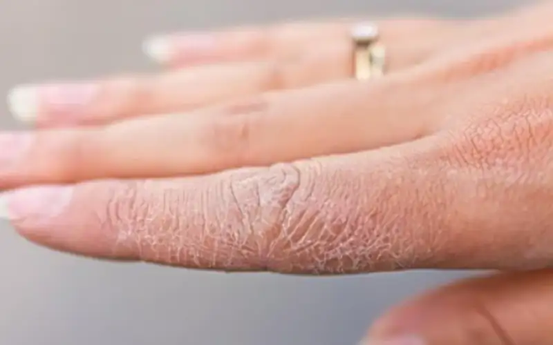 بشرتك تكشف الخطر .. علامات مبكرة