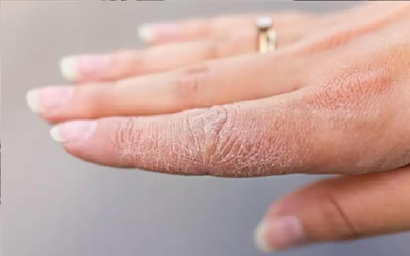 بشرتك تكشف الخطر.. علامات مبكرة للسكري