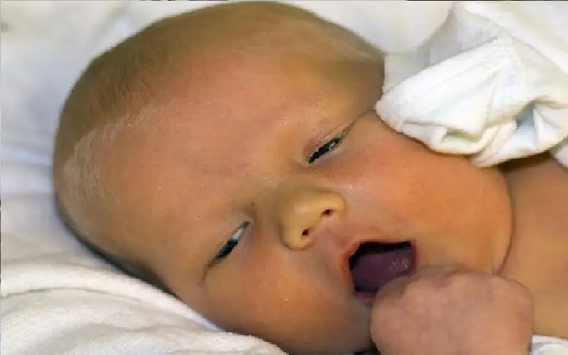 اليرقان وأسبابه ومضاعفاته الصحية