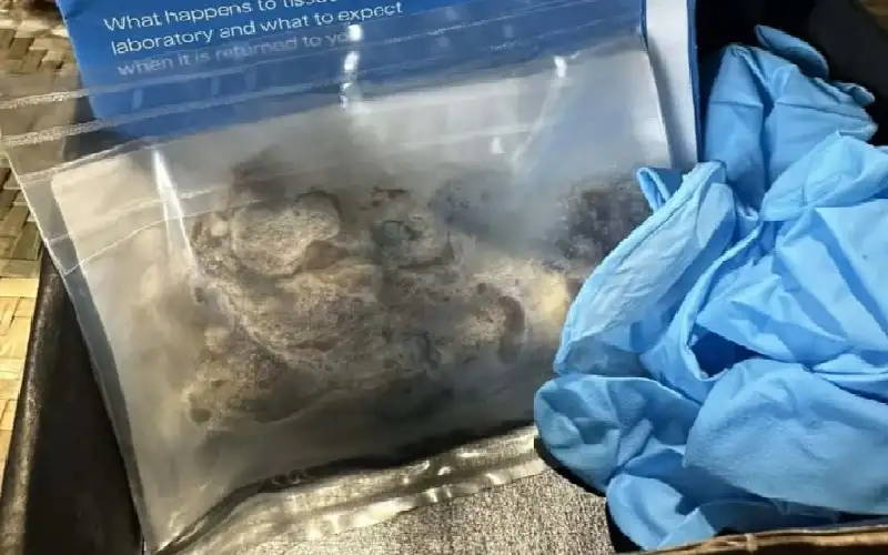 صور مفزعة.. هكذا دمر التدخين الإلكتروني