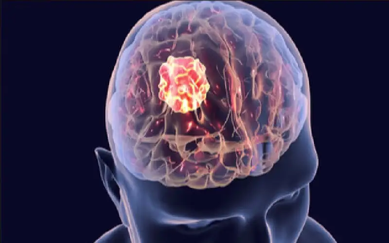 أمل جديد لمرضى سرطان المخ.. قطرات