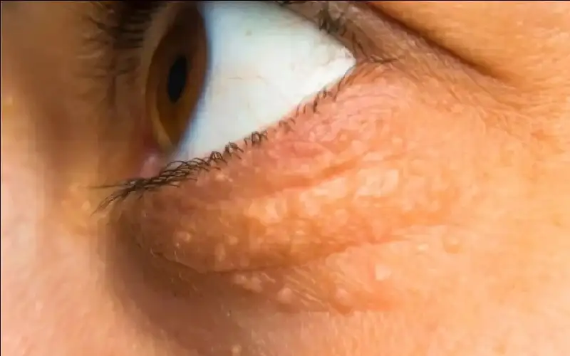 علامتان في الوجه تكشفان عن ارتفاع