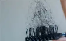 صحة ـ دراسة تكشف كيف يسبب التوتر تساقط