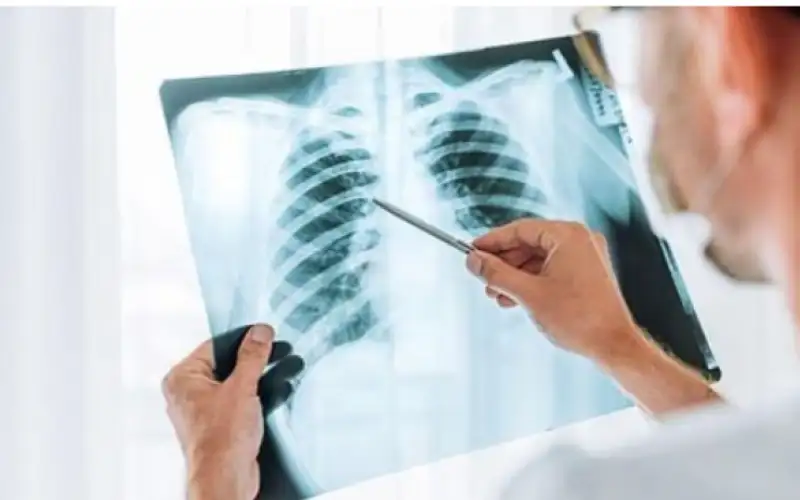 الالتهاب الرئوي .. كيف تحول الإنفلونزا