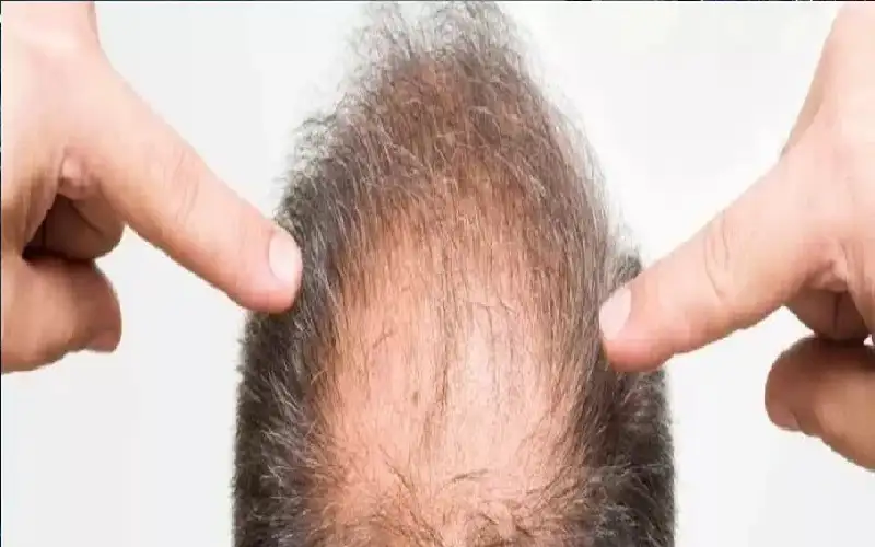 اختراق طبي جديد.. أول علاج موضعي