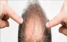 صحة ـ اختراق طبي جديد.. أول علاج موضعي